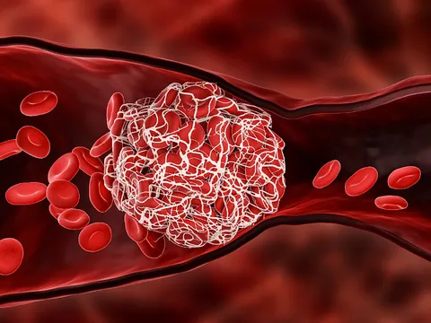 Cảnh giác nguy cơ đột quỵ hậu COVID-19