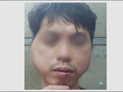 Thanh niên tố bị chủ quán lẩu nướng ở Hà Nội đánh biến dạng khuôn mặt