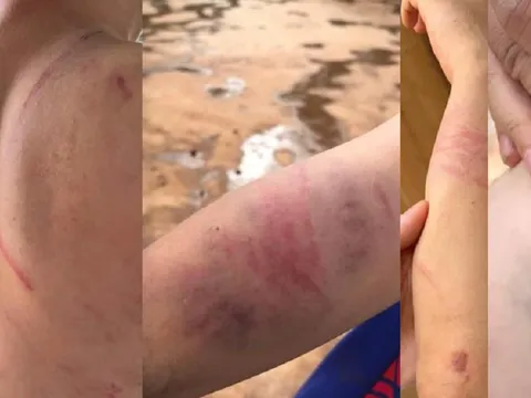 Xác minh thông tin cháu bé 9 tuổi nghi bị cha và bà nội đánh đập