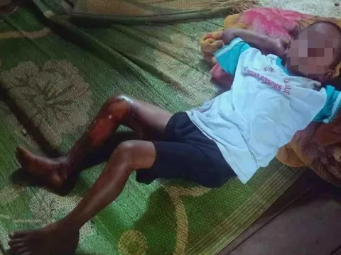 Đắk Lắk: Điều tra nghi án bé trai bị tẩm xăng đốt vì không chịu đi trộm mủ cao su