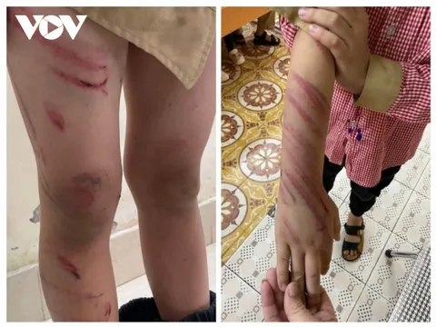 Hải Phòng: Bé trai 8 tuổi nghi bị bạn trai của mẹ đánh bầm tím khắp người