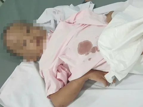 Điều tra vụ bé trai 6 tuổi bỏng cấp độ 2, nghi bị bạo hành ở TP.HCM