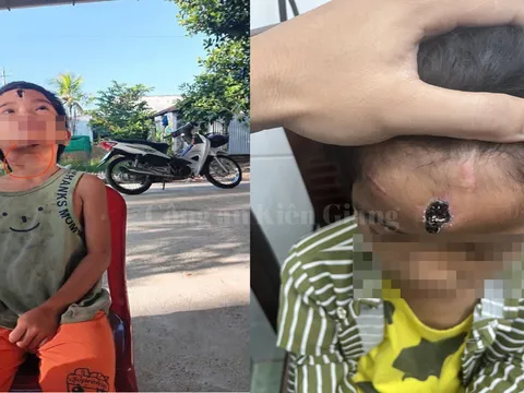 Khởi tố cha dượng hành hạ con riêng của vợ ở Kiên Giang