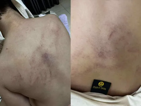 Điều tra vụ bé gái 4 tuổi bị giáo viên mầm non đánh đập, kéo lê, ném vào tường ở Hà Nội